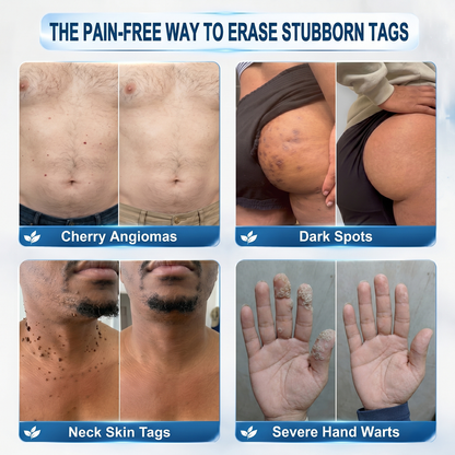 𝐎𝐟𝐟𝐢𝐜𝐢𝐚𝐥 𝐁𝐫𝐚𝐧𝐝 𝐒𝐭𝐨𝐫𝐞 🥇 𝐏i𝐜𝐝o® 7-𝐷𝑎𝑦 𝗧𝐚𝐠 & 𝗦𝗽𝐨𝐭 𝐄𝐫𝒂𝒔𝒆𝒓(Zero Pain, Zero 𝐒𝐜𝐚𝒓𝒔 Rollerball)🏆