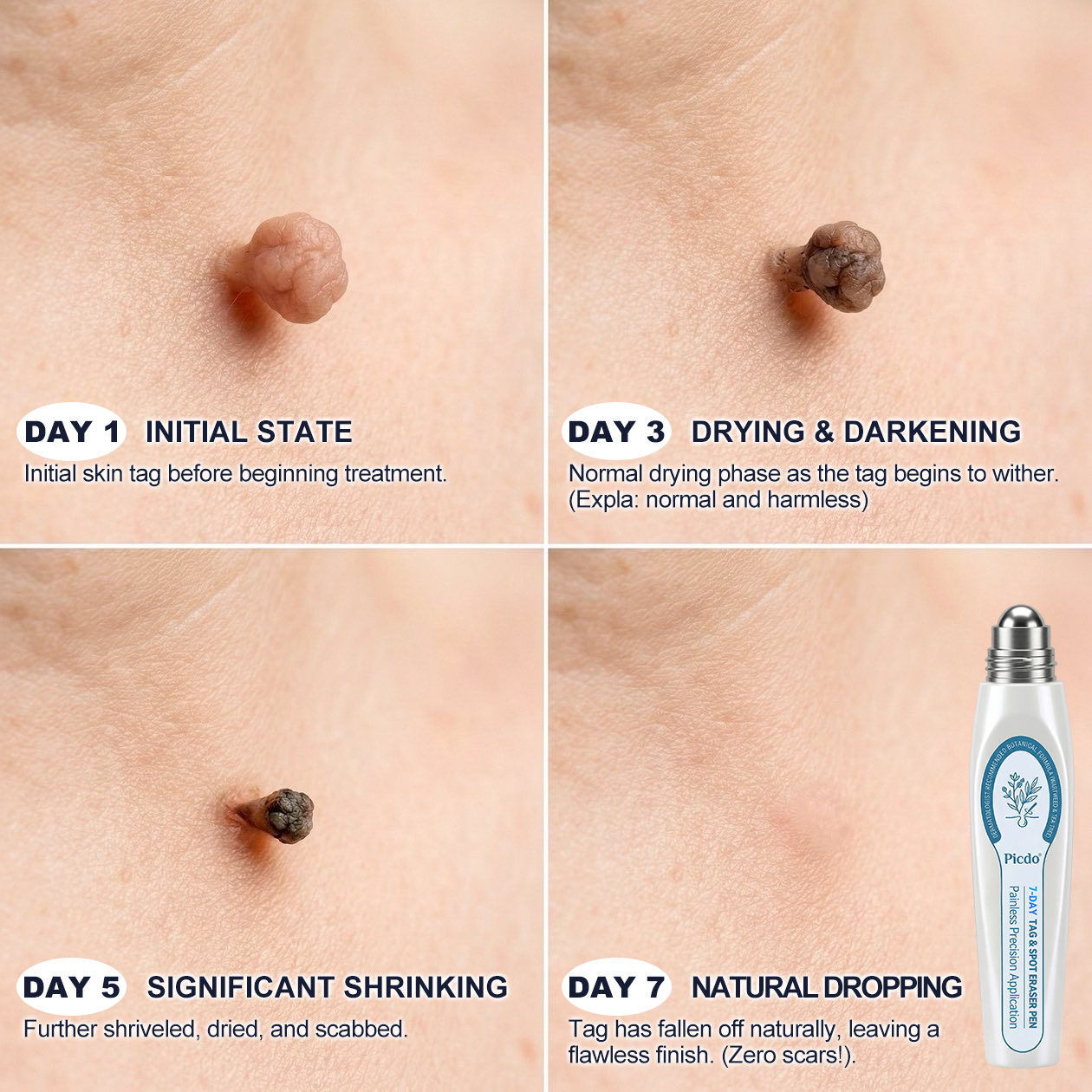 𝐎𝐟𝐟𝐢𝐜𝐢𝐚𝐥 𝐁𝐫𝐚𝐧𝐝 𝐒𝐭𝐨𝐫𝐞 🥇 𝐏i𝐜𝐝o® 7-𝐷𝑎𝑦 𝗧𝐚𝐠 & 𝗦𝗽𝐨𝐭 𝐄𝐫𝒂𝒔𝒆𝒓(Zero Pain, Zero 𝐒𝐜𝐚𝒓𝒔 Rollerball)🏆
