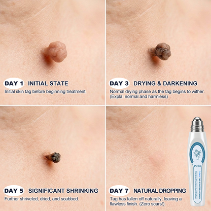 𝐎𝐟𝐟𝐢𝐜𝐢𝐚𝐥 𝐁𝐫𝐚𝐧𝐝 𝐒𝐭𝐨𝐫𝐞 🥇 𝐏i𝐜𝐝o® 7-𝐷𝑎𝑦 𝗧𝐚𝐠 & 𝗦𝗽𝐨𝐭 𝐄𝐫𝒂𝒔𝒆𝒓(Zero Pain, Zero 𝐒𝐜𝐚𝒓𝒔 Rollerball)🏆